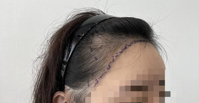 女子发际线8个月经过照片