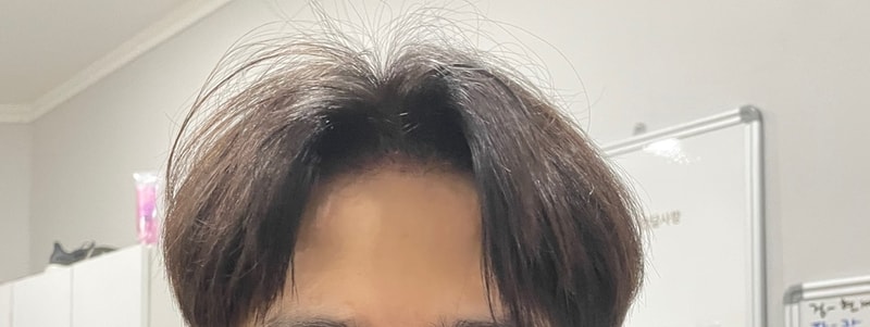 비절개모발이식 1500모낭 두달차