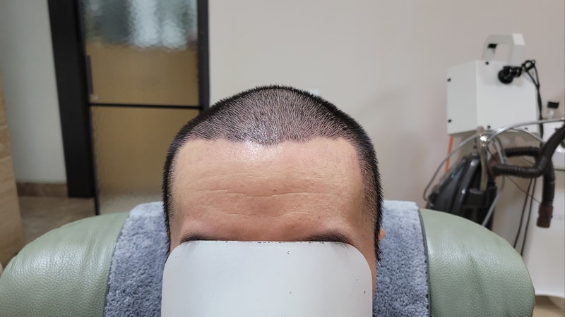 This is the 14th day of mass hair transplantation at Jarada Clinic.