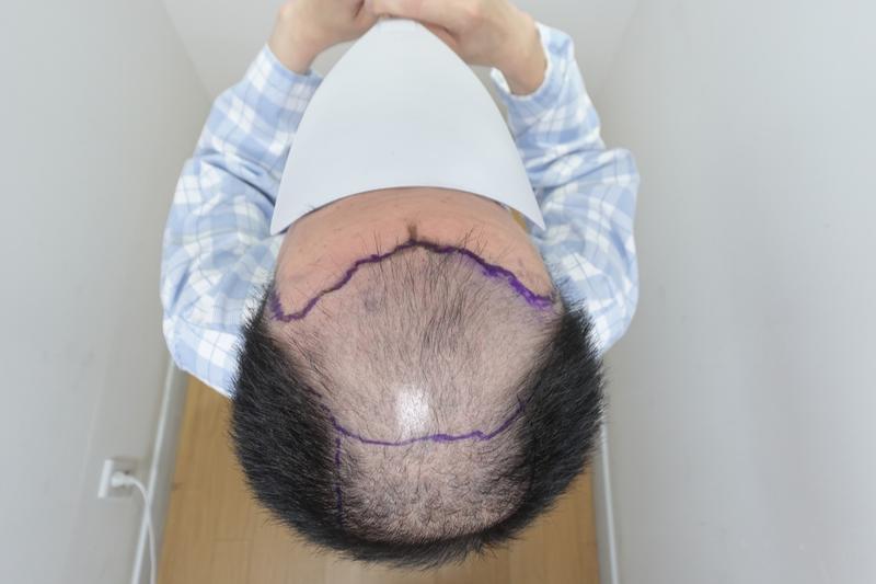 This is the 120th day of mass hair transplantation at Jarada Clinic.