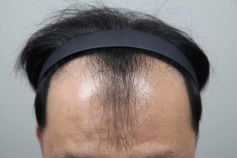 엠자+정수리까지 5000모 대량이식! 4개월차 암흑기 끝났어요!