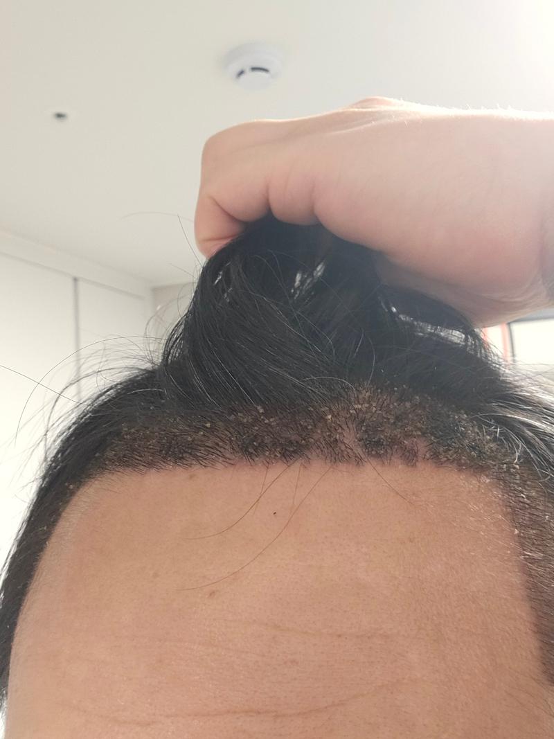 It's been two weeks since I had a hair transplant at Monara Dermatology
