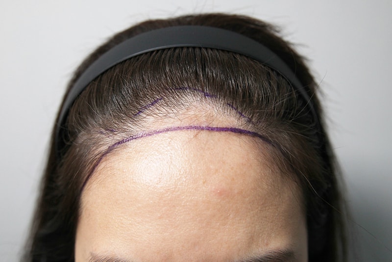 모나라모발이식 5.jpg