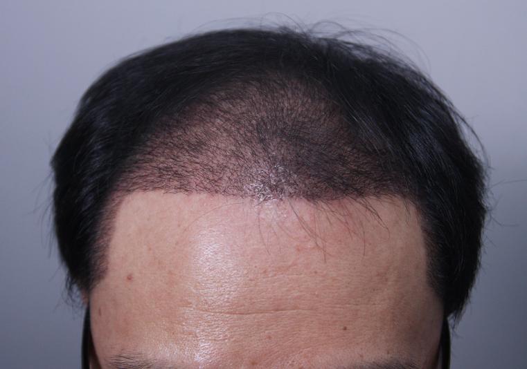 It's been a month since I got a hair transplant
