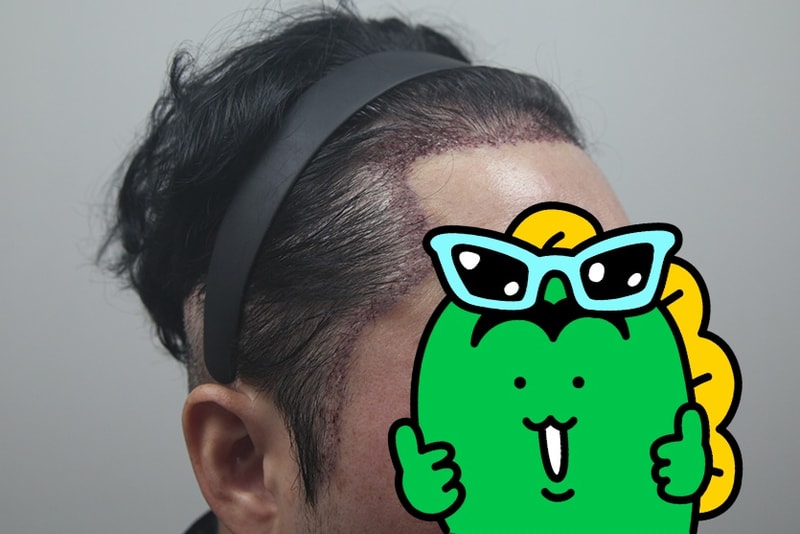 모나라피부과 모발이식 2.jpg