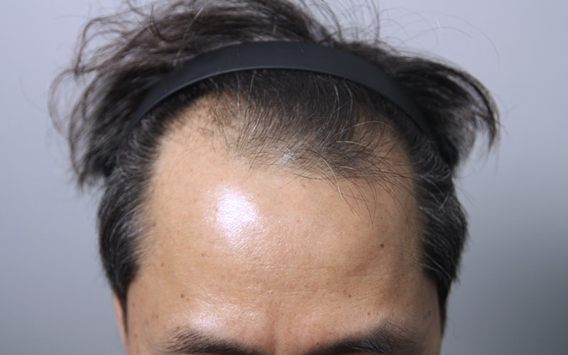 모나라피부과_50대모발이식_1년경과 3.jpg