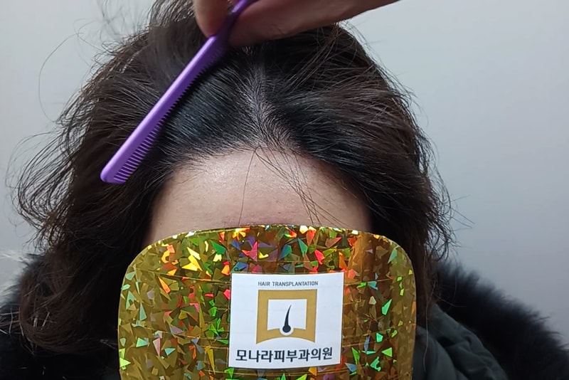 모나라모발이식-4.jpg