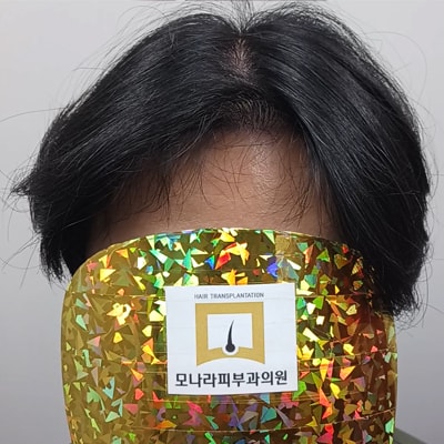 모나라피부과 모발이식 2200모 8개월 경과