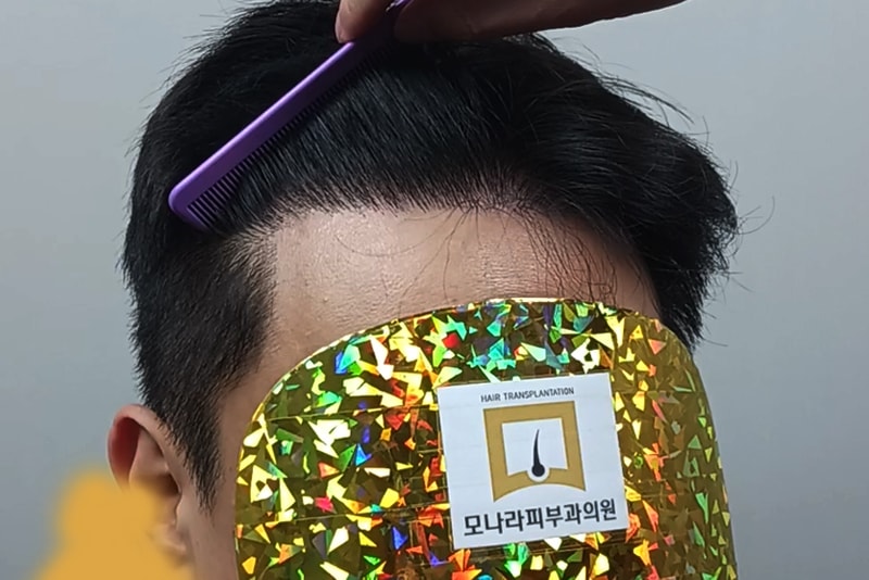 모나라피부과 모발이식 8개월 후기!