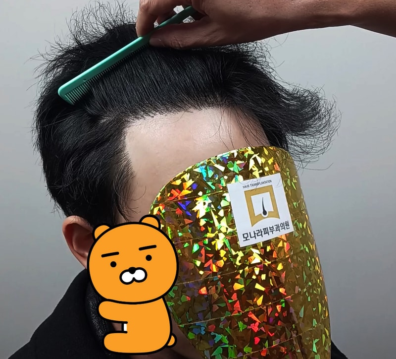 모나라피부과 M자 탈모 모발이식 2800모 12개월 경과