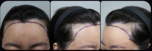 It's been 4 months since Monara's hairline!