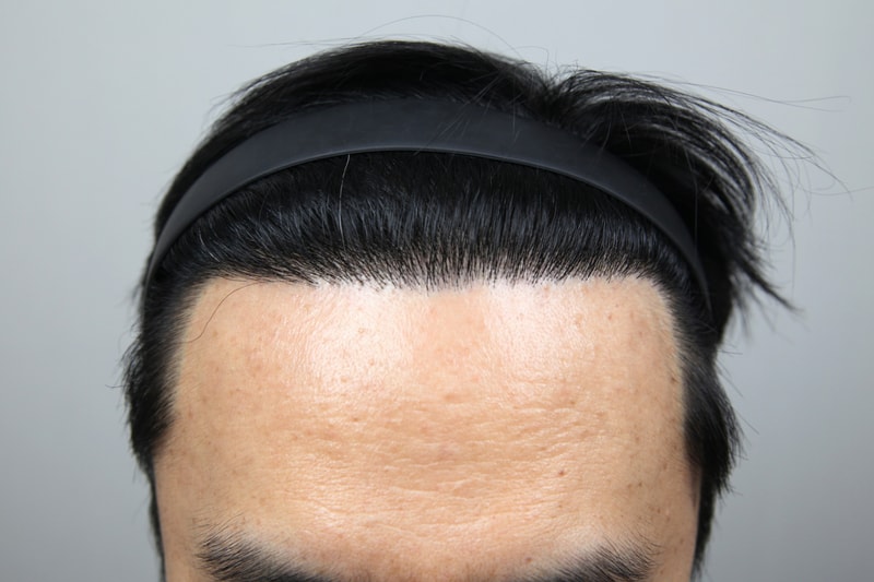 모나라에서 이식받고 최종 경과 1년 됐습니다