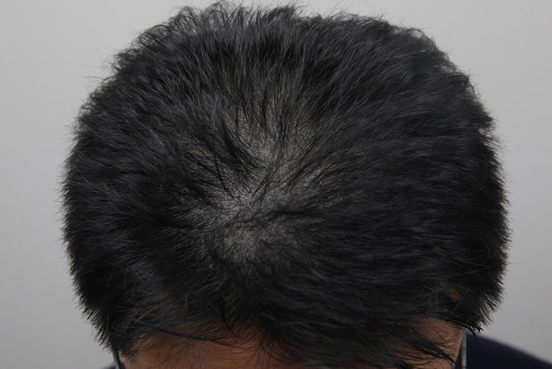 모나라 모발이식 2.jpg