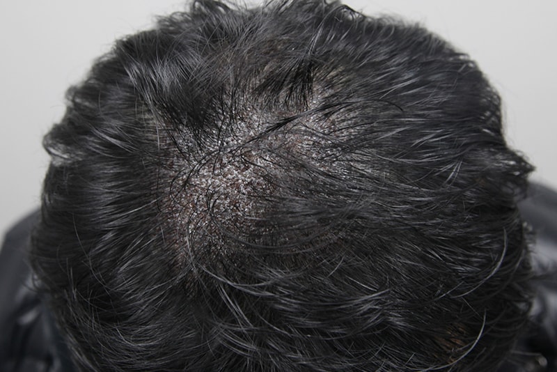 모나라 모발이식 3.jpg