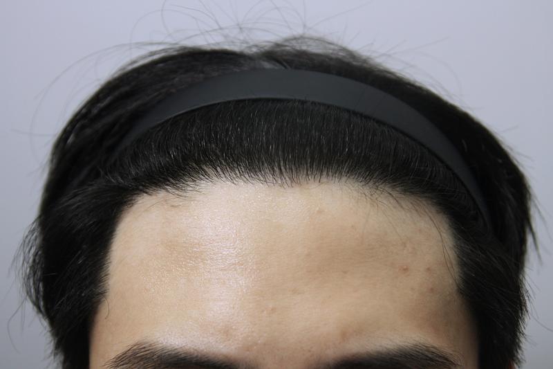 Monara Dermatology Hairline ~ Sideburn Hair Transplantation 8 months have passed