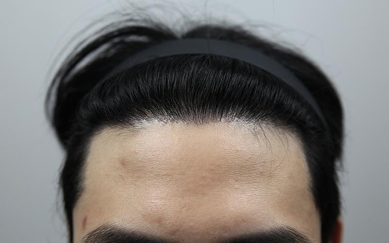 Monara Dermatology Hairline to Sideburn Line After 1 year of correction