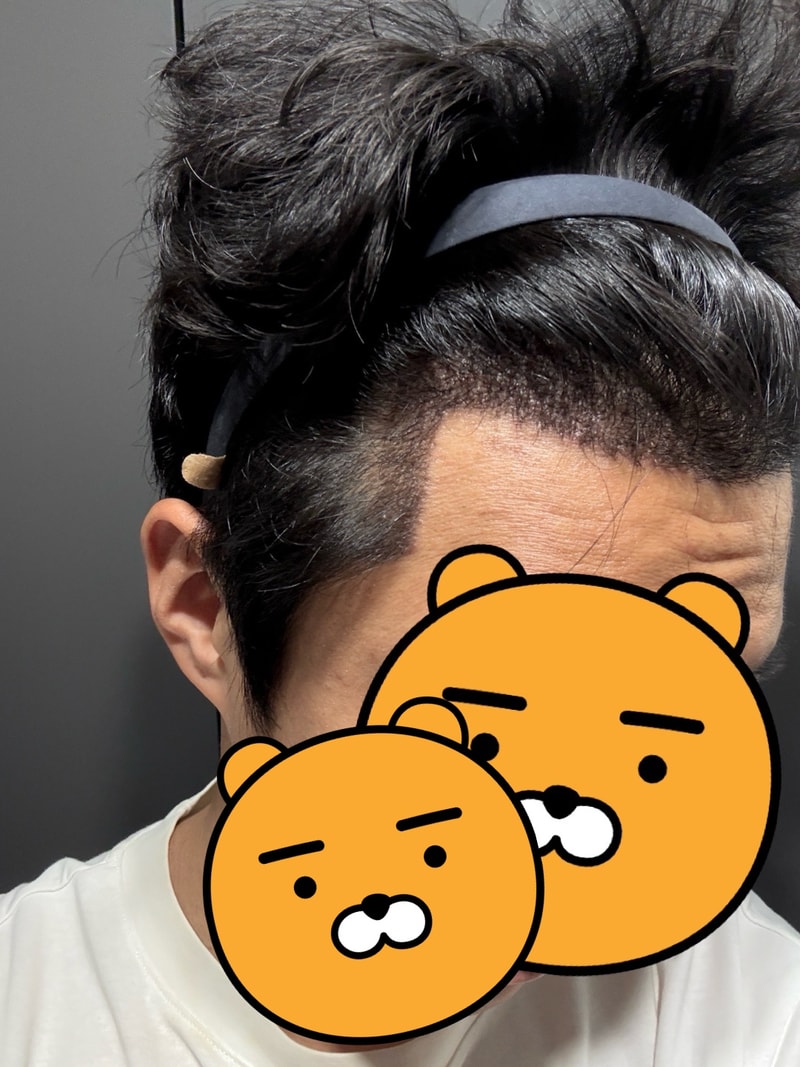 모나라.비절개모발이식 3.jpg