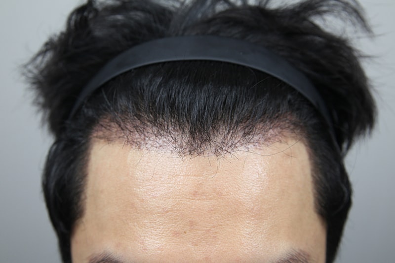 모발이식 재수술 모나라 1달차 암흑기 왔네요! (1차 5년전 타병원)