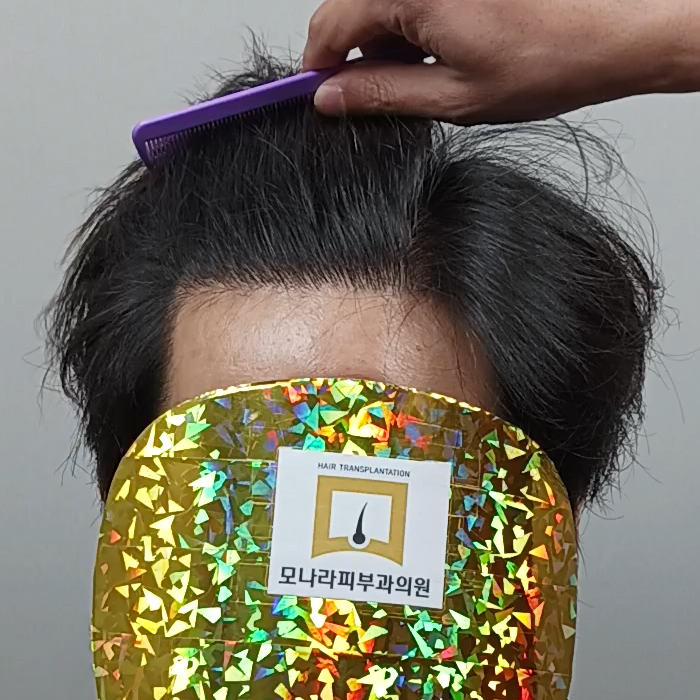 모나라모발이식 2.jpg