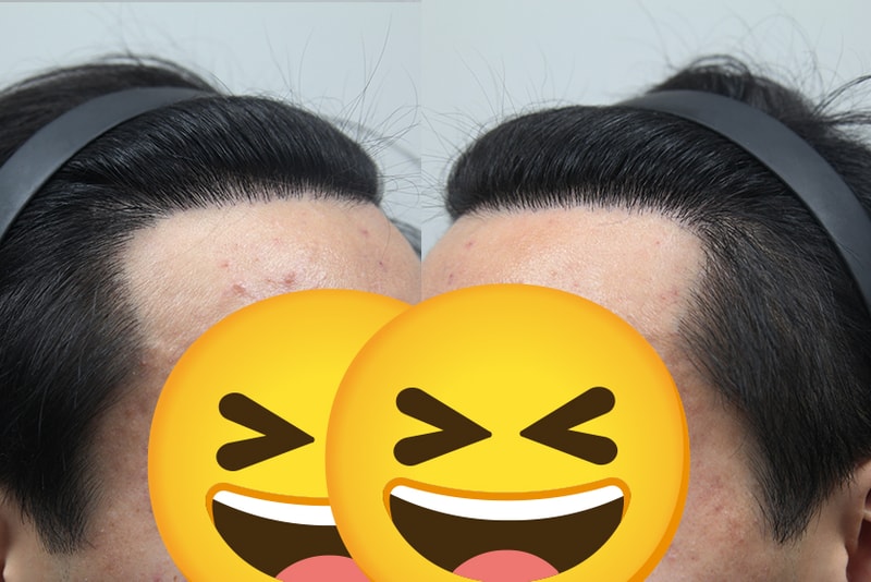 남자헤어라인 모발이식 모나라피부과 3.jpg