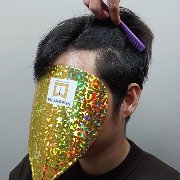 모나라모발이식 4.jpg