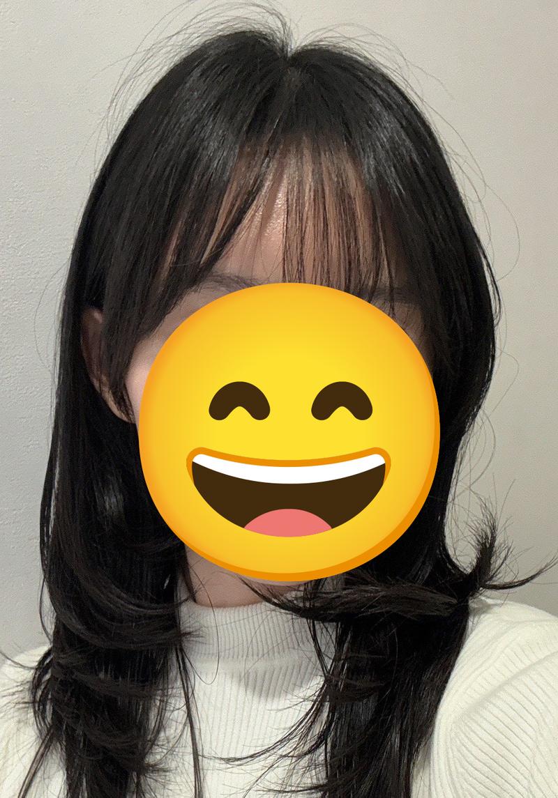 모나라피부과 여성 헤어라인 교정 3800모 4달차 후기