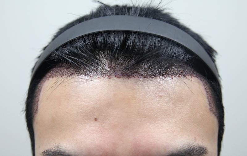 Monara Dermatology Department Non-Cutting Hair Transplantation 1000 Hair follicles on Day 7