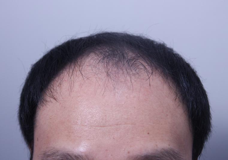 After a lot of thought, I got a hair transplant!
