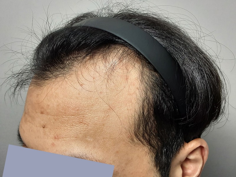 모나라피부과 모발이식 5.jpg