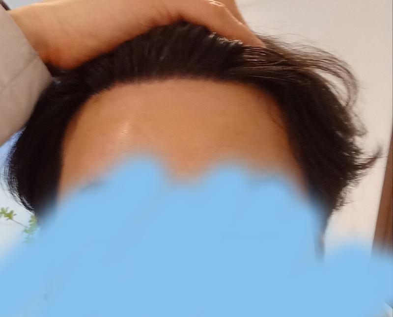 모나라 피부과 모발이식 1년 경과 5.jpg