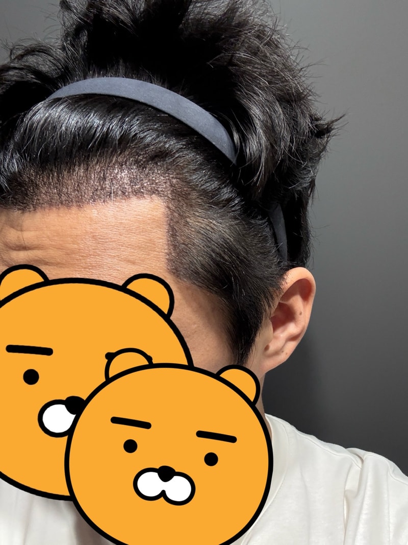 모나라.비절개모발이식 2.jpg