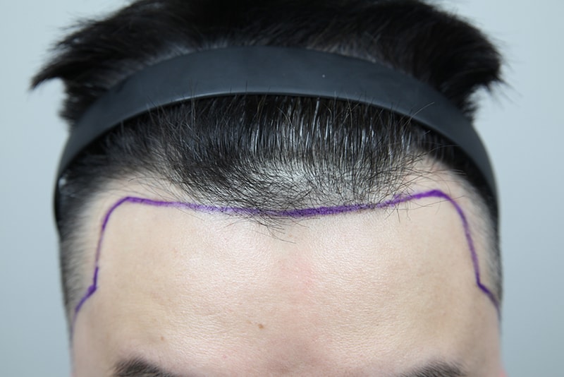 I've had hair transplants from the hairline to the sideburns!