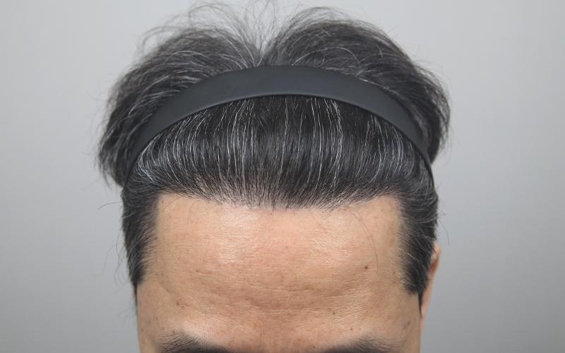 모나라피부과_50대모발이식_1년경과 6.jpg