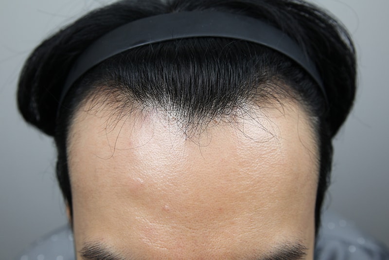 친구 추천으로 김대우 원장님에게 모발이식 받은 1일 후기!