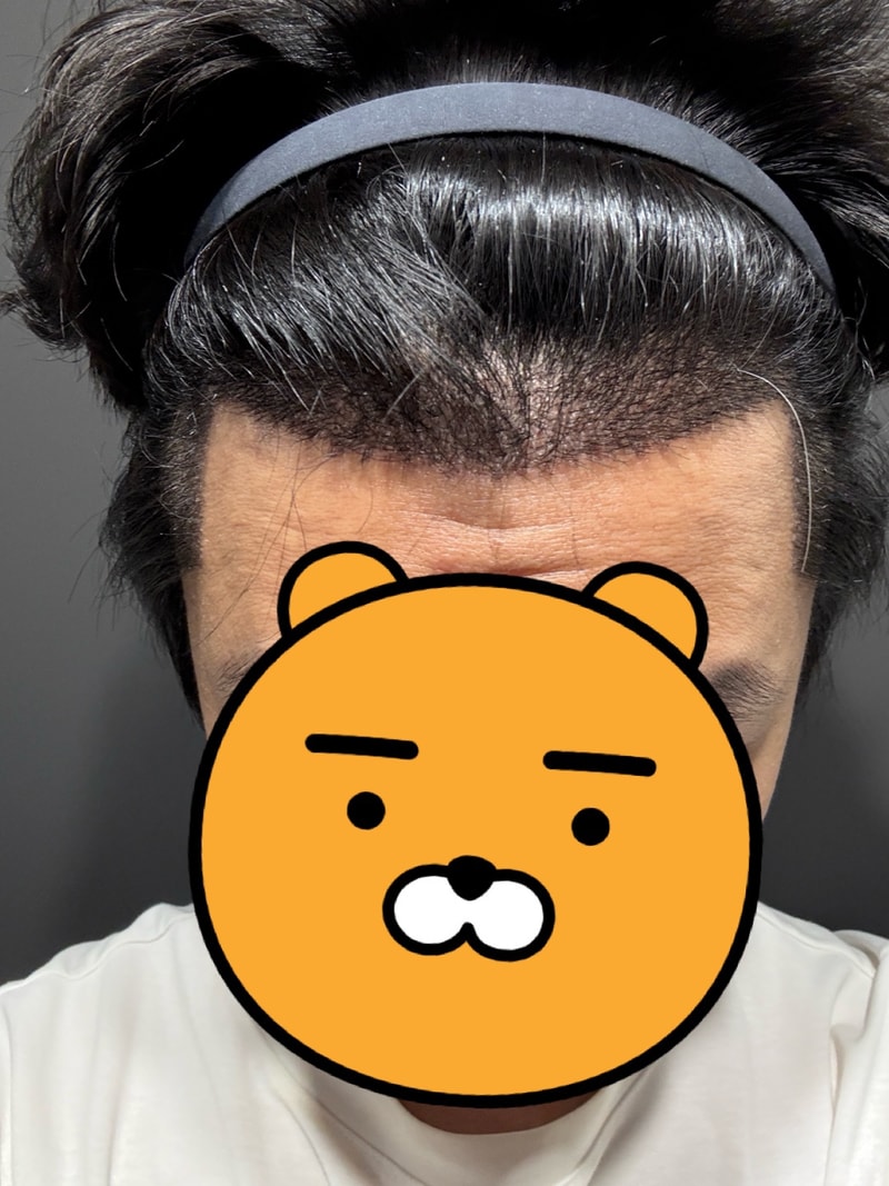 모발이식 재수술 모나라 15일차 됐습니다! (1차 5년전 타병원)