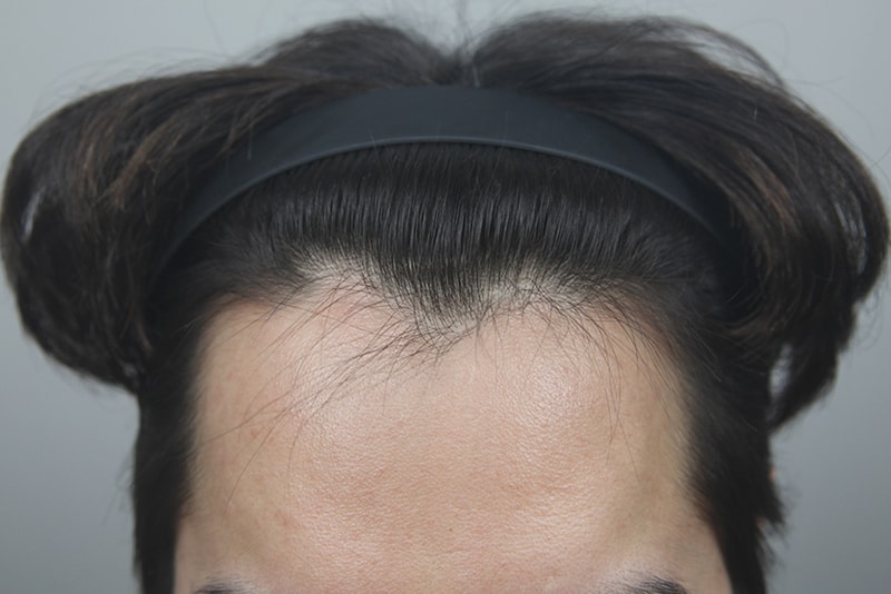 デコボコして曖昧なヘアライン··· 毛髪移植ですっきり変身、スタート！