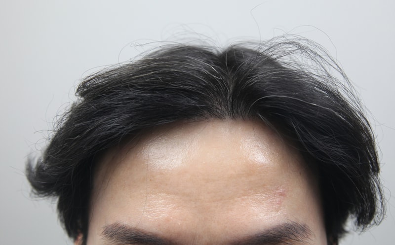 모나라 피부과 모발이식 1년 경과 8.jpg