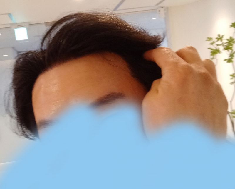 모나라 피부과 모발이식 1년 경과 4.jpg