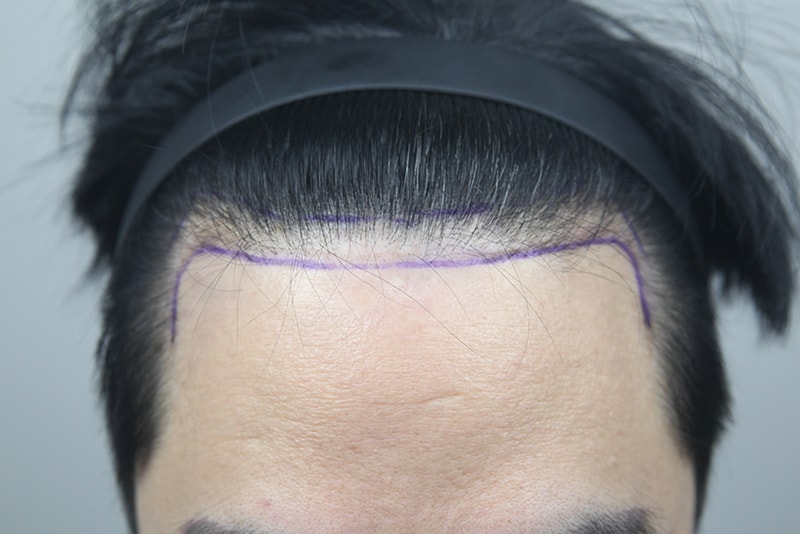 정수리, 헤어라인 모발이식! 모나라에서 두피문신 후 모발이식까지