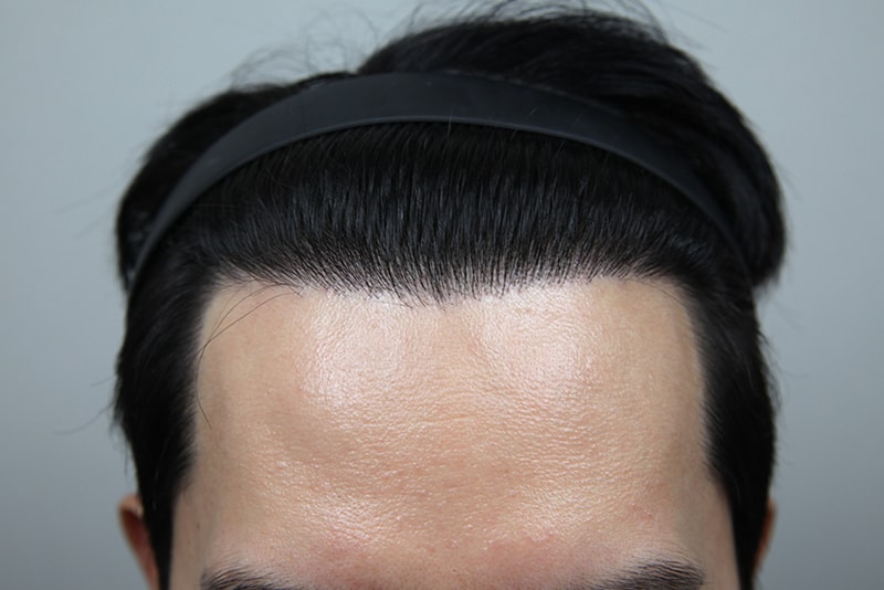 Monara Hairline Hair Transplant 1 year review!