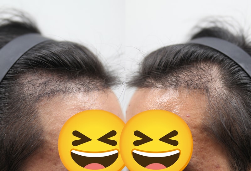 남자헤어라인-모발이식-모나라피부과-4개월경과.jpg