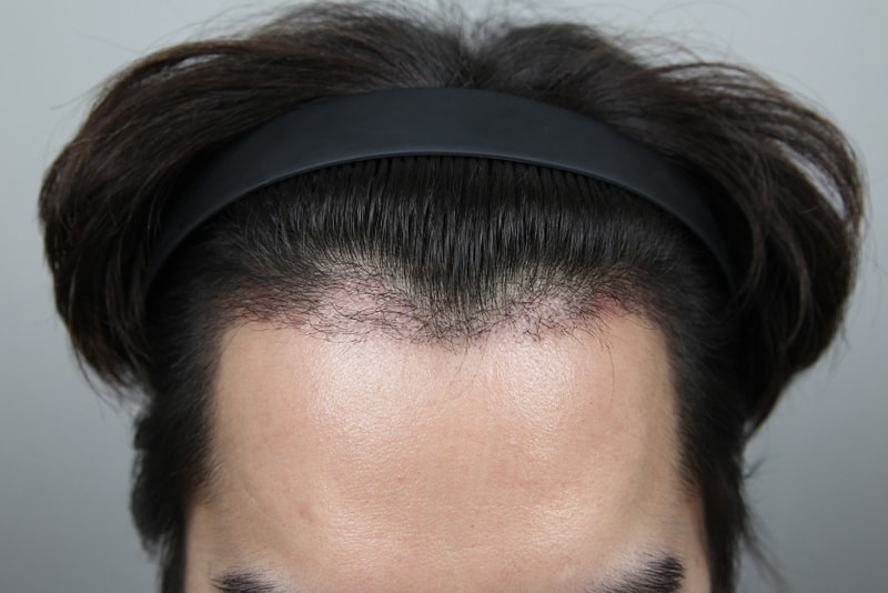 デコボコして曖昧なヘアライン··· 暗黒期······ ぼそぼそと上がってくる坊主