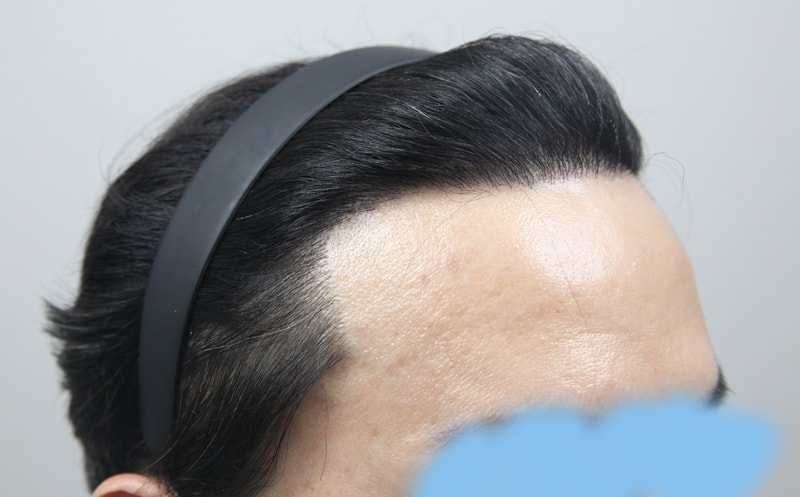모나라 피부과 모발이식 1년 경과 6.jpg