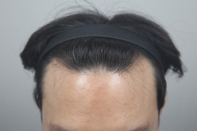 측면까지 디테일 살려 디자인해주는 모나라, 모발이식 1일차 후기