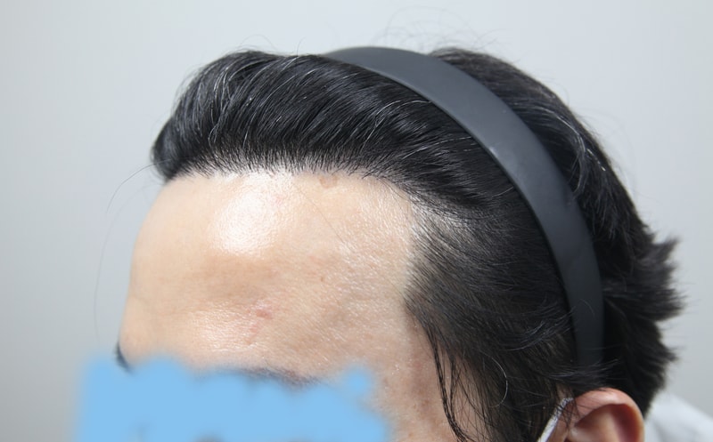 모나라 피부과 모발이식 1년 경과 7.jpg