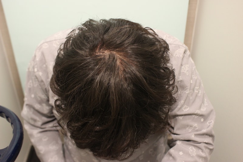 It's been 80 days since the top of the head hair transplant of 3,500 hairs.