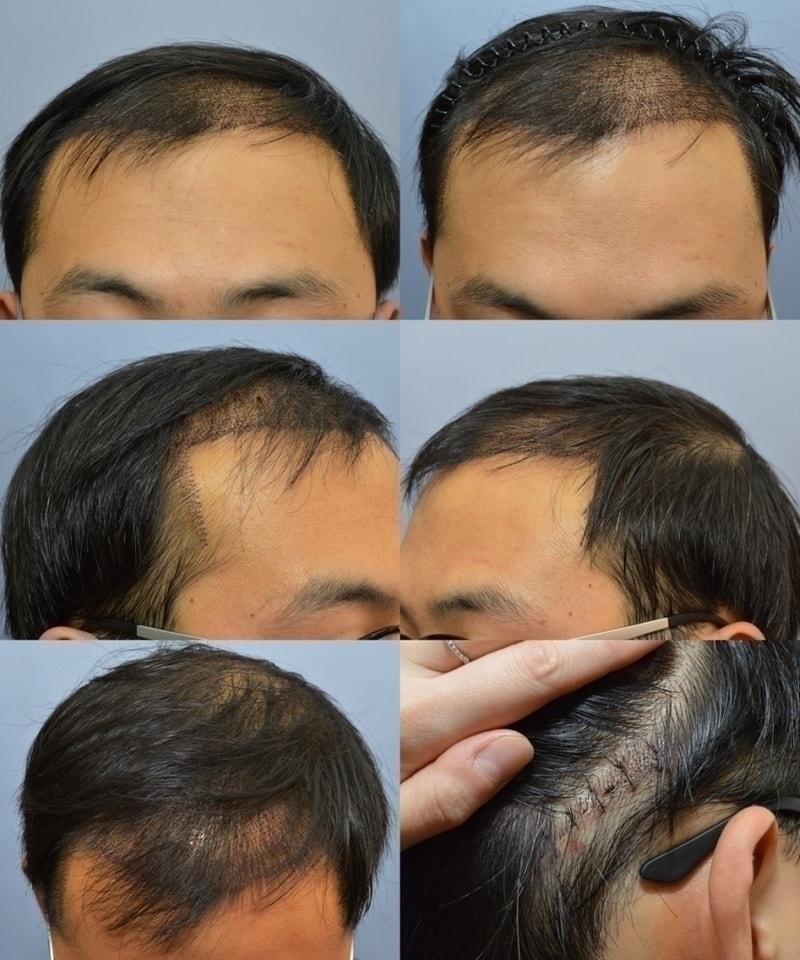 수술5일차.jpg
