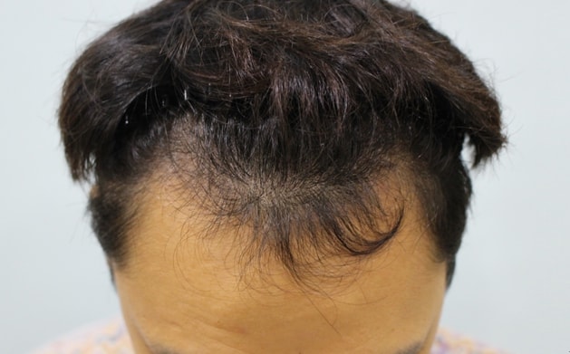 Emza, Forehead Hair Transplantation 7-8 Months (Including the area where hair cystitis occurred)