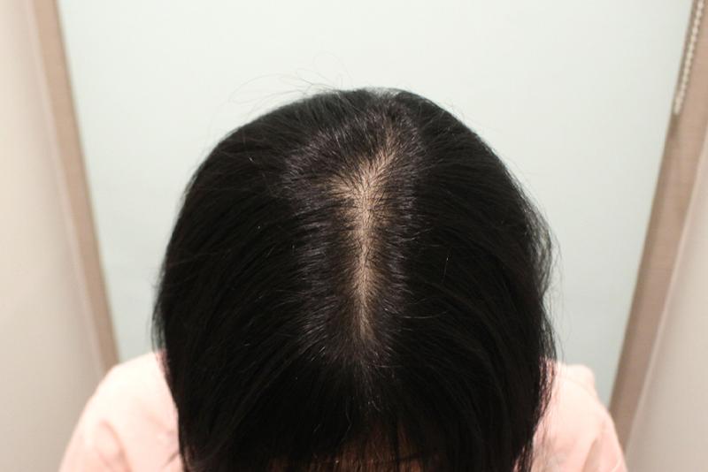 Six months have passed since hair transplantation (picture needs to be enlarged)