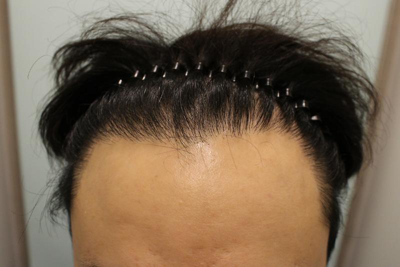 전두부 헤어라인 밀도 확실하지 말입니다!